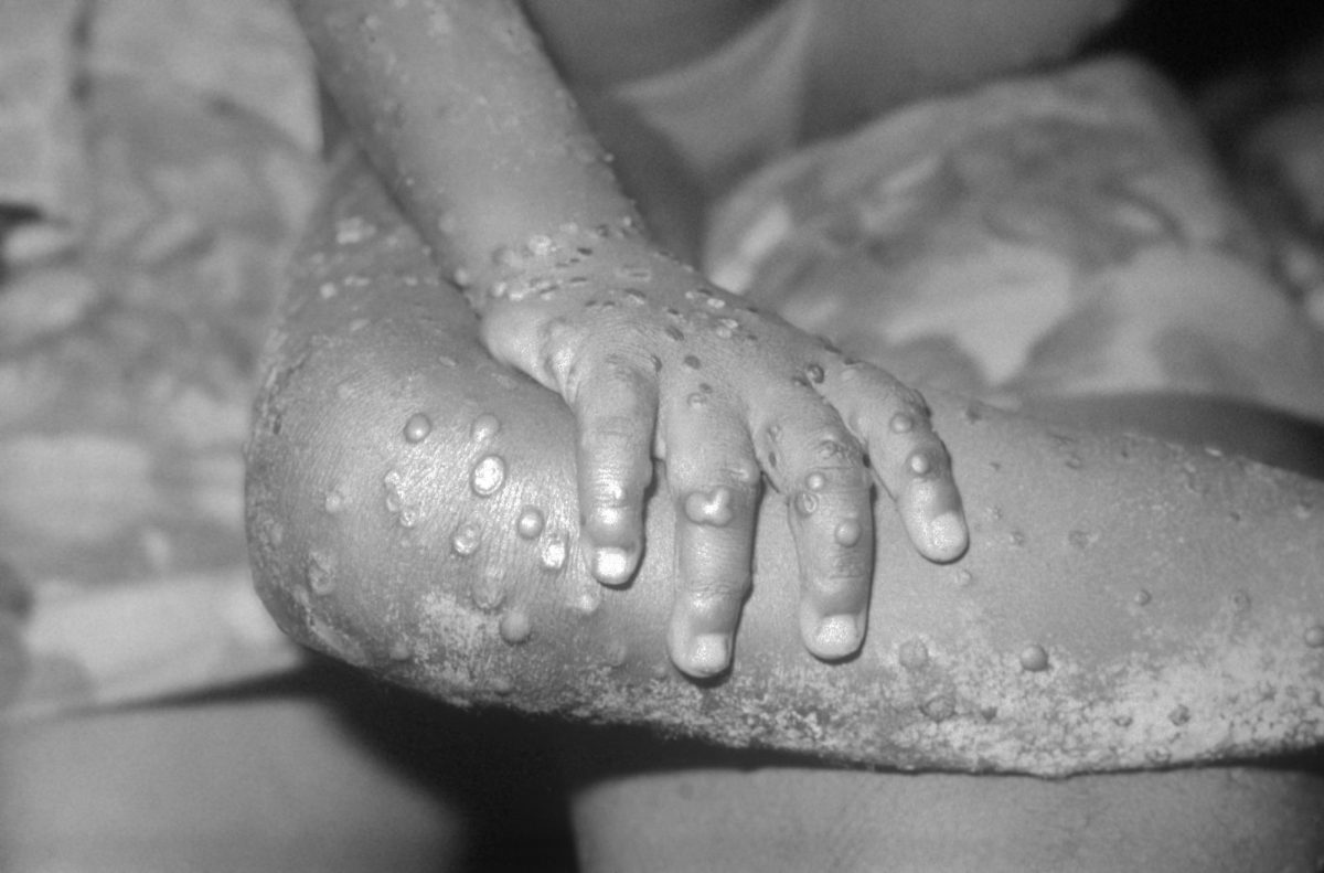 Is Monkeypox Virus a Real Threat?